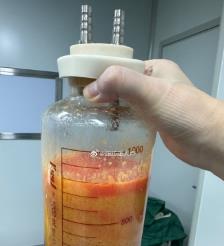 水动力吸脂手术要做多久？